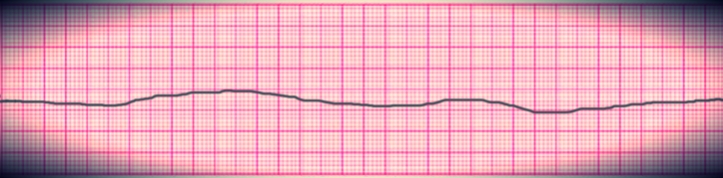 Graphic representation of no electric activity (shocks) as no defibrillation is done.