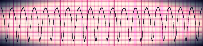 Ventricular tachycardia - good response after defibrillation and cardiac electrical shocks
