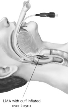 airway with laryngeal mask