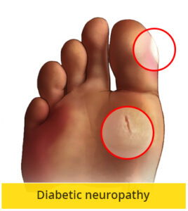 diabetic neuropathy in relation to diabetes