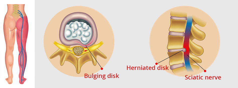 disk herniation and sciatic nerve - spine affections