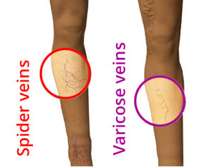 varicose and spider veins